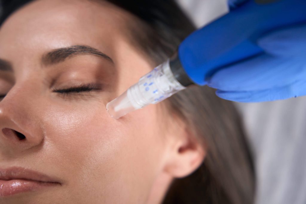 Microneedling procedure in progress on a woman's face, highlighting skin rejuvenation and natural healing, with a focus on enhancing skin texture and radiance.